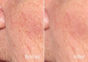 Befor-After nuna ultra