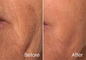 Befor-After nuna ultra